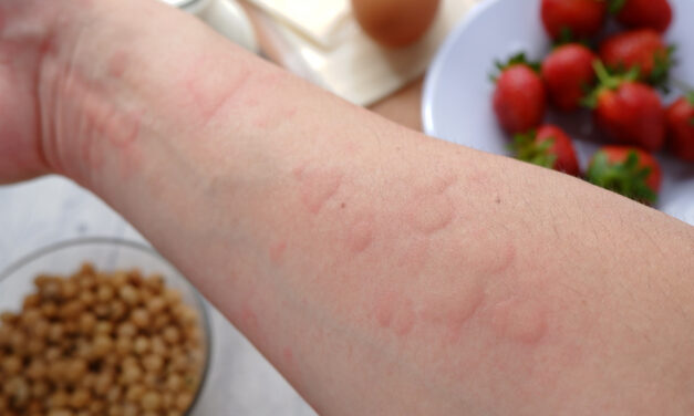 A few sentences about acute hives (and dispelling another misconception)