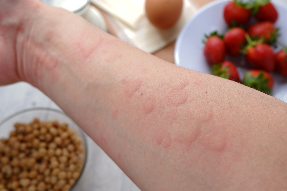 A few sentences about acute hives (and dispelling another misconception)