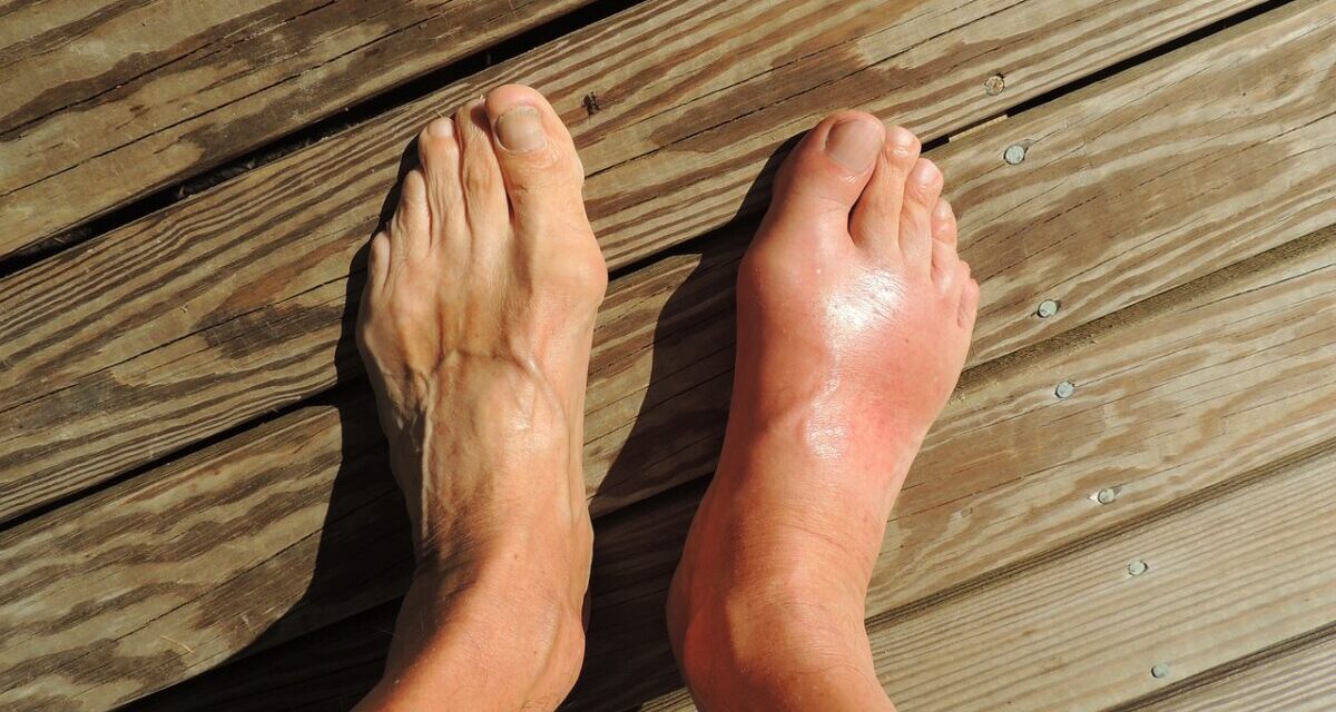 A few sentences about the high uric acid level that causes gout