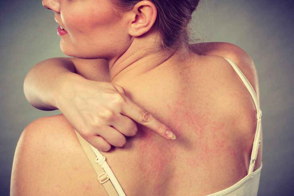 csalánkiütés urticaria