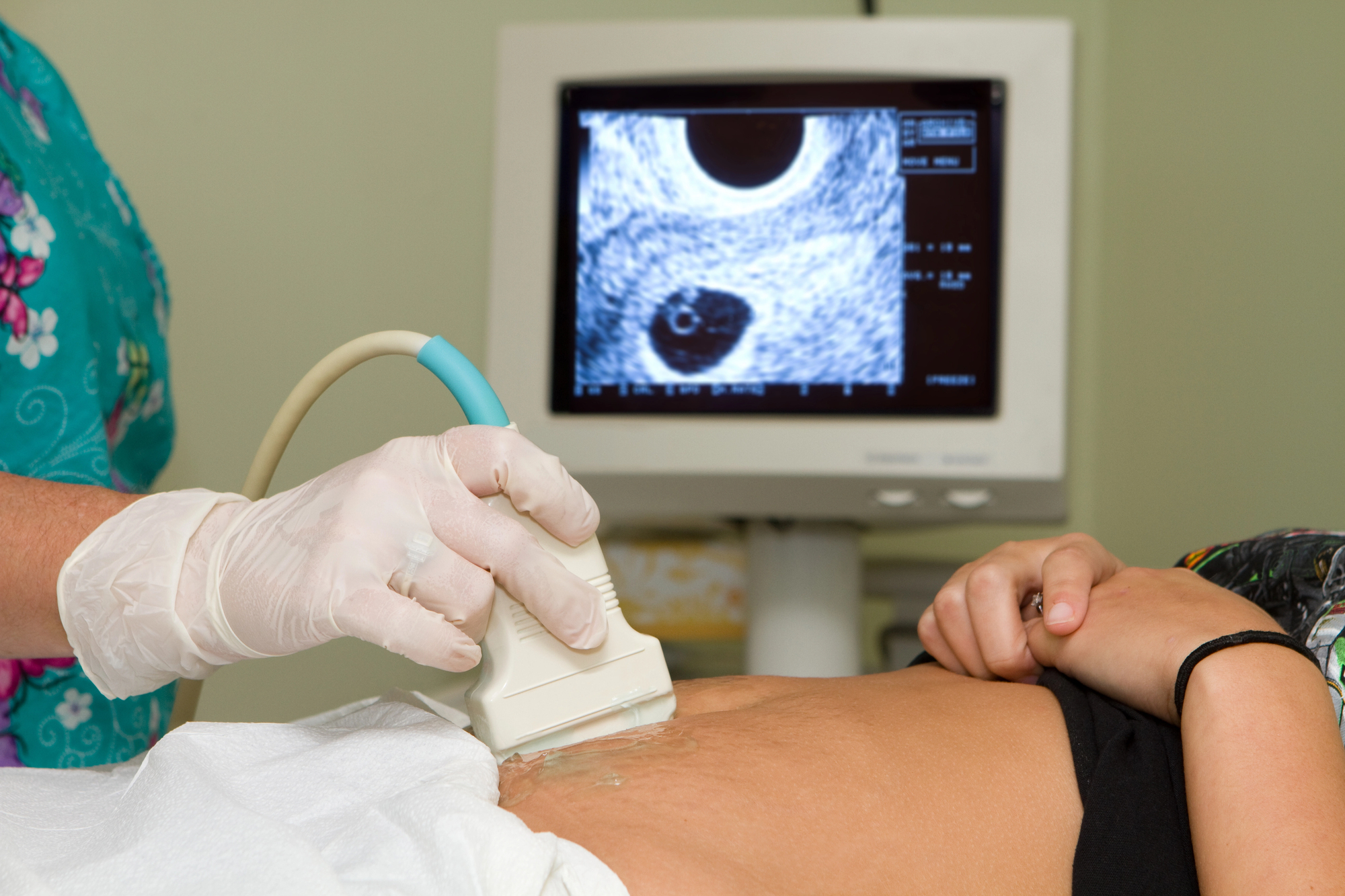 terhes abortusz gyermekvállalás ultrahang